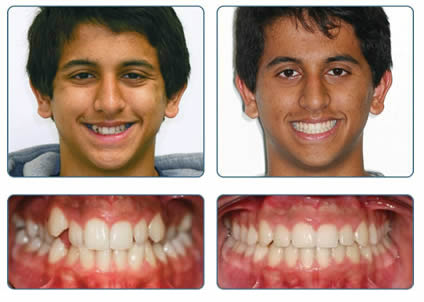 Braces and orthodontics to straighten teeth in Tamworth