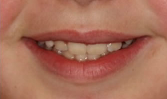 After Cosmetic Dentistry