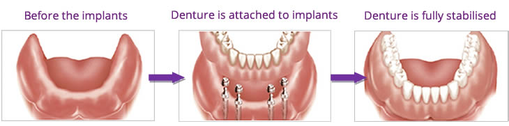 Dental implants combined with a denture