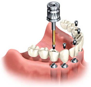 Dental  bridge secured with implants to the lower jaw