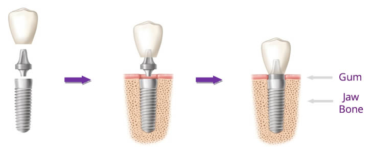 Dental implant placement process