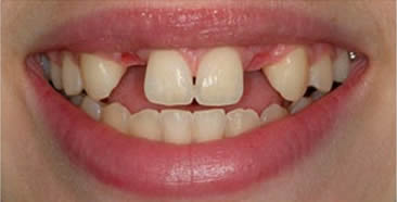 Before dental implants