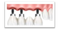 dental implants Sutton Coldfield Birmingham to replace several missing teeth