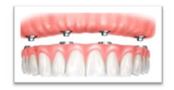 dental implants Sutton Coldfield Birmingham to replace all missing teeth