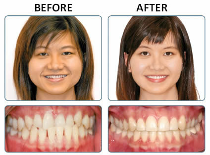 Insignia braces and orthodontist in Walsall