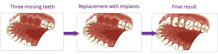 implants to replace multiple missing teeth