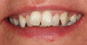 Before Orthodontic treatment