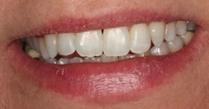After orthodontic  treatment