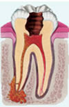 Infected tooth and abscess